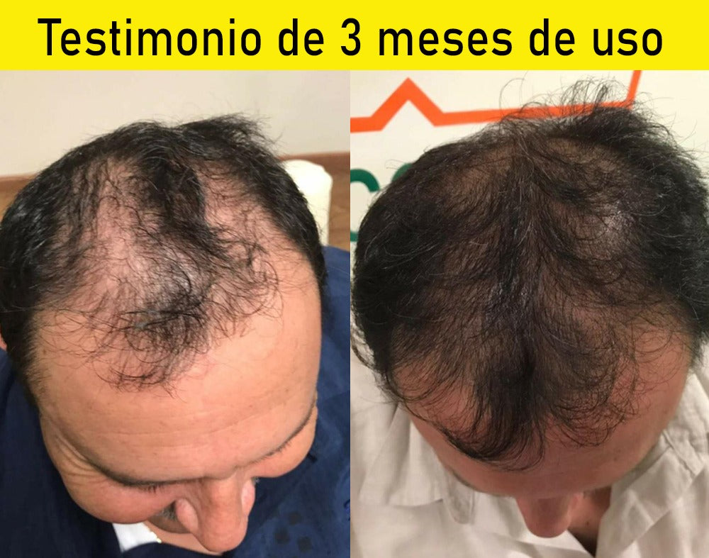 Champú Anticaída - Shampoo Anticaída